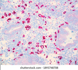 Endometrium Tissue Infiltrated By Numerous Natural Killer Cells Which Cause Infertility. The Cells Are Red With This CD 56 Stain. Microscopic View.