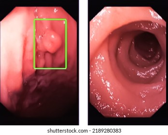 Endoscope technology concept. 3d rendering endoscopic inside of intestine gastric polyp.