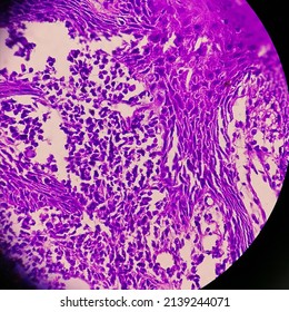 Endoscopic Biopsy Of  Mid Oesophagus  Tissue Shows Invasive Squamous Cell Carcinoma Grade-2