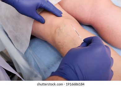 Endovasal laser coagulation-the surgeon removes varicose veins with a laser. - Shutterstock ID 1916686184