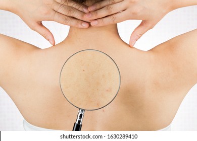 Enlarge The Back Acne With A Loupe.