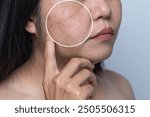 Enlarged circles indicate facial skin problems such as blemishes, freckles, uneven skin tone and large pores on combination skin. Dull and rough skin The concept of good health

