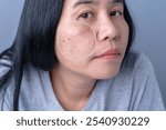 Enlarged circles indicate facial skin problems such as blemishes, freckles, uneven skin tone and large pores on combination skin. Dull and rough skin The concept of good health	