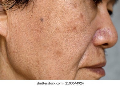 Enlarged Pores In Face Of Southeast Asian, Chinese Elder Man With Skin Folds.