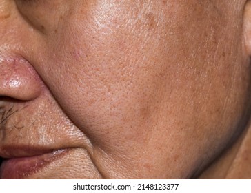 Enlarged Pores In Oily Face Of Southeast Asian, Chinese Elder Man With Skin Folds.