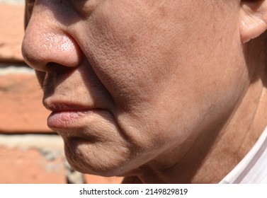 Enlarged Pores In Oily Face Of Southeast Asian, Chinese Elder Man With Skin Folds.