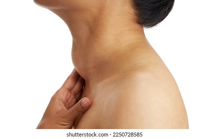 Enlarged thyroid gland, Woman with enlarged thyroid gland on white background  