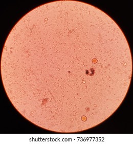 Entamoeba coli cyst form and Blastocystis hominis vacuolated form found in stool examination, stool parasite Stock Photo