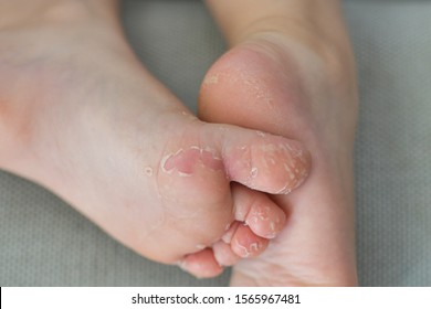 Enterovirus foot hand mouth Skin peeled off on the body of a child Cocksackie virus