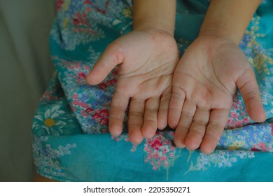 Enterovirus Leg - Arm - Mouth. Rash On The Body Of A Child. Cocksackie Virus.