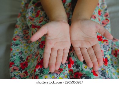 Enterovirus Leg - Arm - Mouth. Rash On The Body Of A Child. Cocksackie Virus.