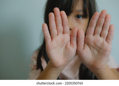 Enterovirus Leg - Arm - Mouth. Rash On The Body Of A Child. Cocksackie Virus.