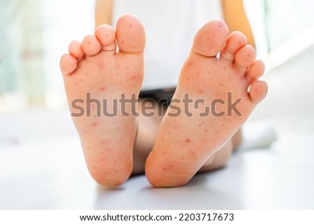 Enterovirus Leg - arm - mouth. Rash on the body of a child. Cocksackie virus. High quality photo