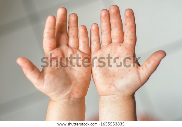 Enterovirus Leg Arm Mouth Rash On Stock Photo (Edit Now) 1655553835