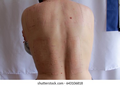 Epicutaneous test reading on the back skin