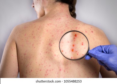 Epidemic Rubella Viral Infection Concept. Skin Bubble Rash