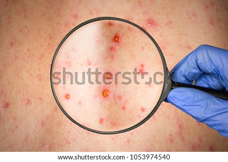 epidemic Rubella viral infection concept. skin bubble rash