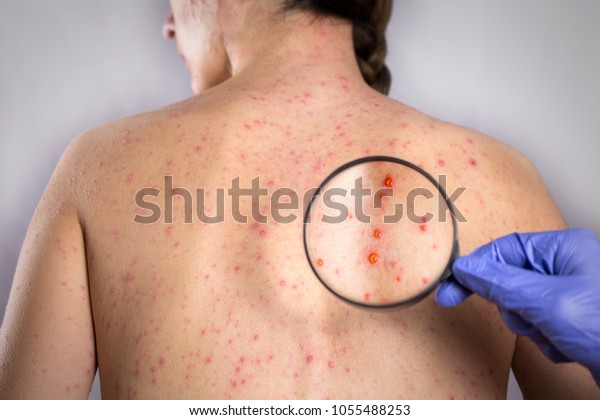 流行性ルベラウイルス感染のコンセプト 皮膚泡発疹 の写真素材 今すぐ編集