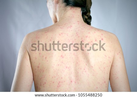 epidemic viral infection psoriasis concept. girls back skin rashes