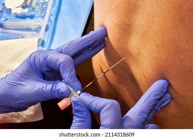 Epidural anesthesia. Anesthesiologist installing an epidural catheter for a patient