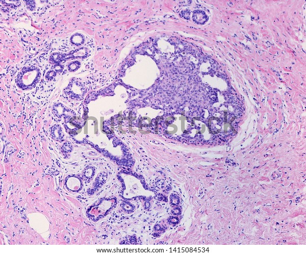 Epithelial hyperplasia. The lumen of\
lactiferous duct is filled by a mixed population of luminal and\
myoepithelial cell types. Irregularslitlike fenestrations are\
prominent at the\
periphery