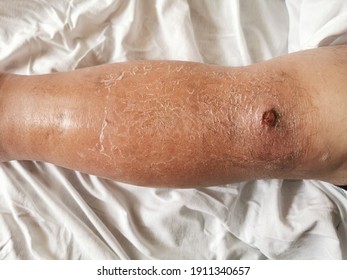 Erysipelas Is A Bacterial Infection In The Upper Layer Of The Skin