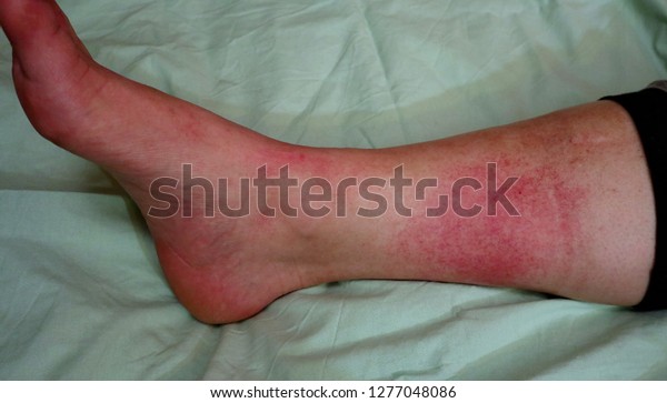 Erysipelas is a bacterial infection in the\
upper layer of the skin. It occurs when Group A Streptococcus\
bacteria penetrate the outer barrier of your skin. Penicillin\
antibiotics treat\
Erysipelas