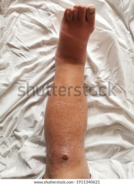 Erysipelas is a bacterial infection in the upper\
layer of the skin