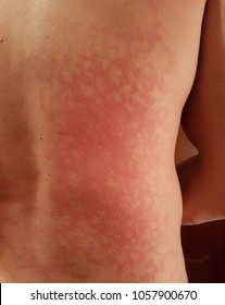 Erythema Ab Ignis Or Heat Dermatitis