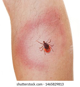 An Erythema Migrans rash often seen in the early stage of Lyme disease. It can appear after a tick bite. It is an actual skin infection with the Lyme bacteria, Borrelia burgdorferi.