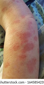 Erythema Multiforme Annular Erythematous Targetoid Skin Lesions