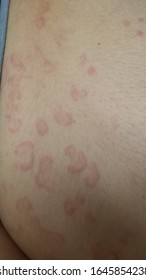 Erythema Multiforme Annular Erythematous Targetoid Skin Lesions