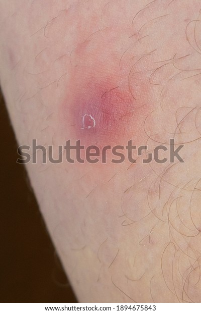 Erythema nodosum, red nodule or lump on inner thigh of a male patient.