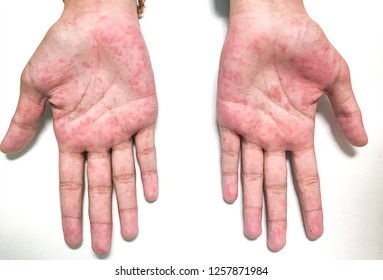 Erythematous Macular Rash On Both Palms.