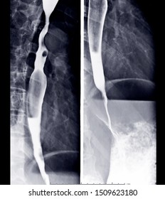 Esophagram Or Barium Swallow AP View Compare AfterThe Patient Drinks A Liquid That Contains Barium Showing Esophagus.