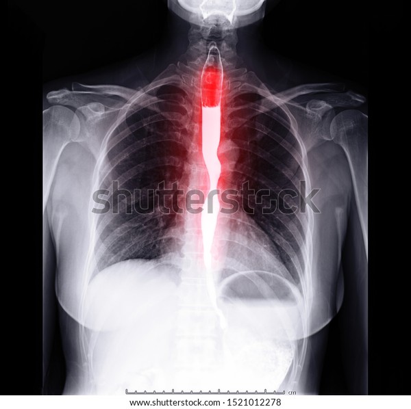 Esophagram or Barium swallow Front view  showing\
esophagus for diagnosis GERD or Gastroesophageal reflux disease and\
Esophageal cancer.