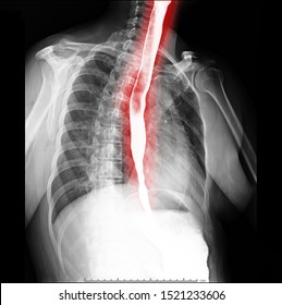 Esophagram Or Barium Swallow Oblique View  Showing Esophagus For Diagnosis GERD Or Gastroesophageal Reflux Disease