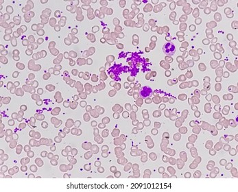 Essential thrombocytosis blood smear showing abnormal high volume of platelet and low count of White Blood Cell analyze by microscope. Leucopenia and  thrombocythemia. Microscopic zooming image.