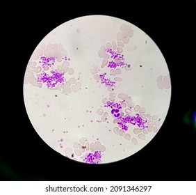 Essential Thrombocytosis Blood Smear Showing Abnormal High Volume Of Platelet And Low Count Of White Blood Cell Analyze By Microscope. Leucopenia And  Thrombocythemia. Microscopic Zooming Image.