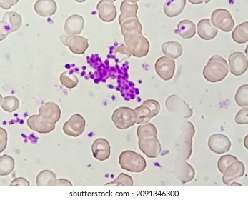 Essential Thrombocytosis Blood Smear Showing Abnormal High Volume Of Platelet And Low Count Of White Blood Cell Analyze By Microscope. Leucopenia And  Thrombocythemia. Microscopic Zooming Image.