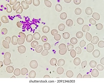 Essential Thrombocytosis Blood Smear Showing Abnormal High Volume Of Platelet And Low Count Of White Blood Cell Analyze By Microscope. Leucopenia And  Thrombocythemia. Microscopic Zooming Image.