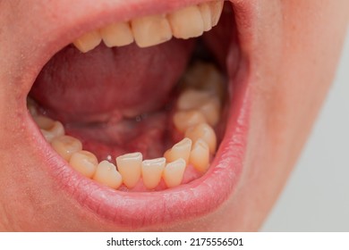 European male open mouth crooked yellow teeth dry lips front view