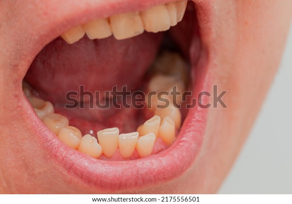 European male open mouth crooked yellow teeth dry\
lips front view