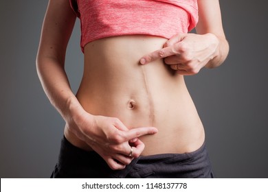 European woman with long abdominal scars after operation standing on black color