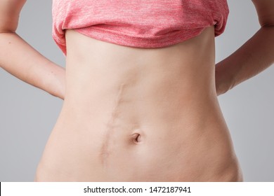 European woman with long abdominal scars after operation standing on white color