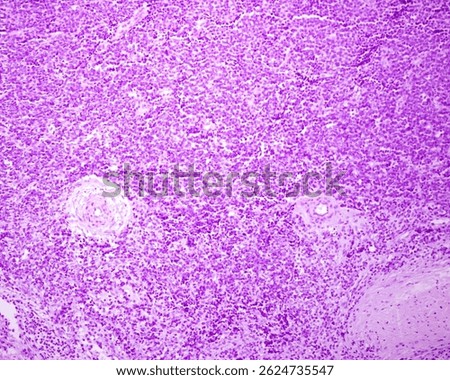 Ewing sarcoma, a rare primary neoplasm of bone. The micrograph shows a uniform population of cells having small, round to oval nuclei. The cytoplasmic boundaries are indistinct