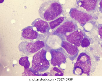 Ewings Sarcoma