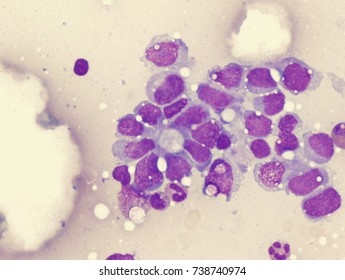 Ewings Sarcoma