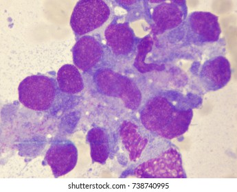 Ewings Sarcoma