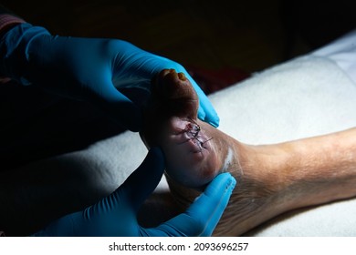 Examination Of The Amputation Of The First Toe Of A Diabetic Elderly Person With Staple Suture And Surgical Thread